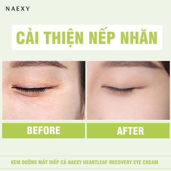 Cải thiện nếp nhăn