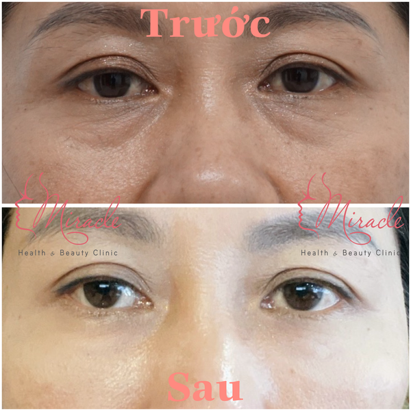 CẤY MỠ TỰ THÂN TRẺ HOÁ VÙNG MẮT