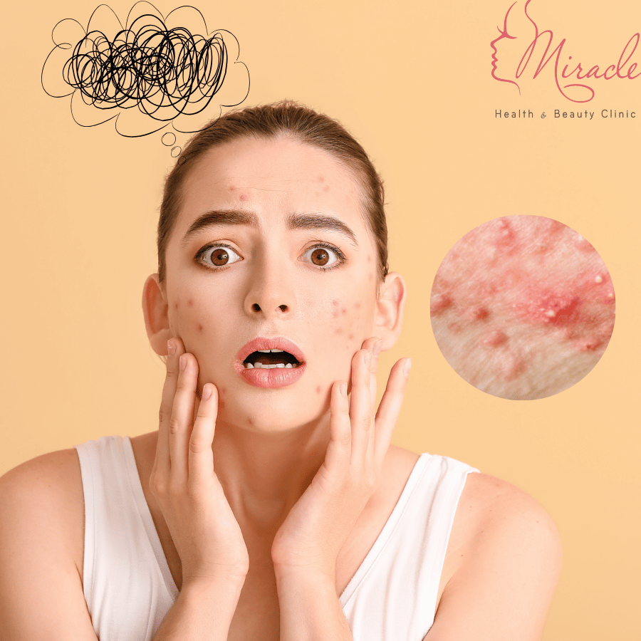 Mụn Trứng Cá: Nguyên Nhân, Chẩn Đoán và Điều Trị Hiệu Quả