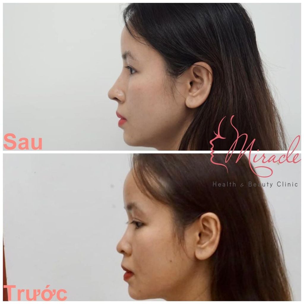 NÂNG MŨI SỤN TỰ THÂN VỚI TS. KIỀU THƠ