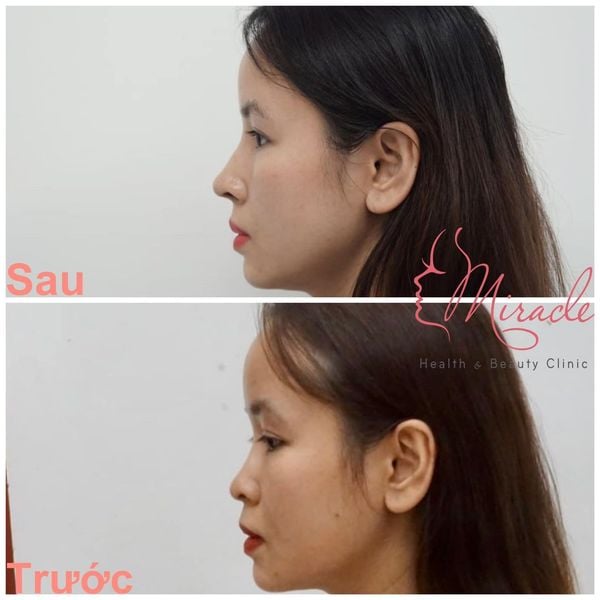 NÂNG MŨI SỤN TỰ THÂN VỚI TS. KIỀU THƠ