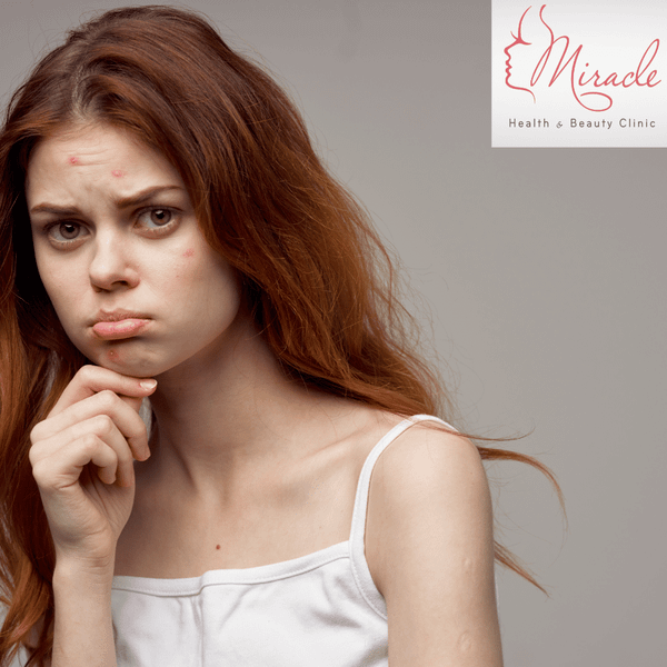 “Tôi bị mụn, tại sao bác sĩ da liễu khuyên nên đi khám phụ khoa?”