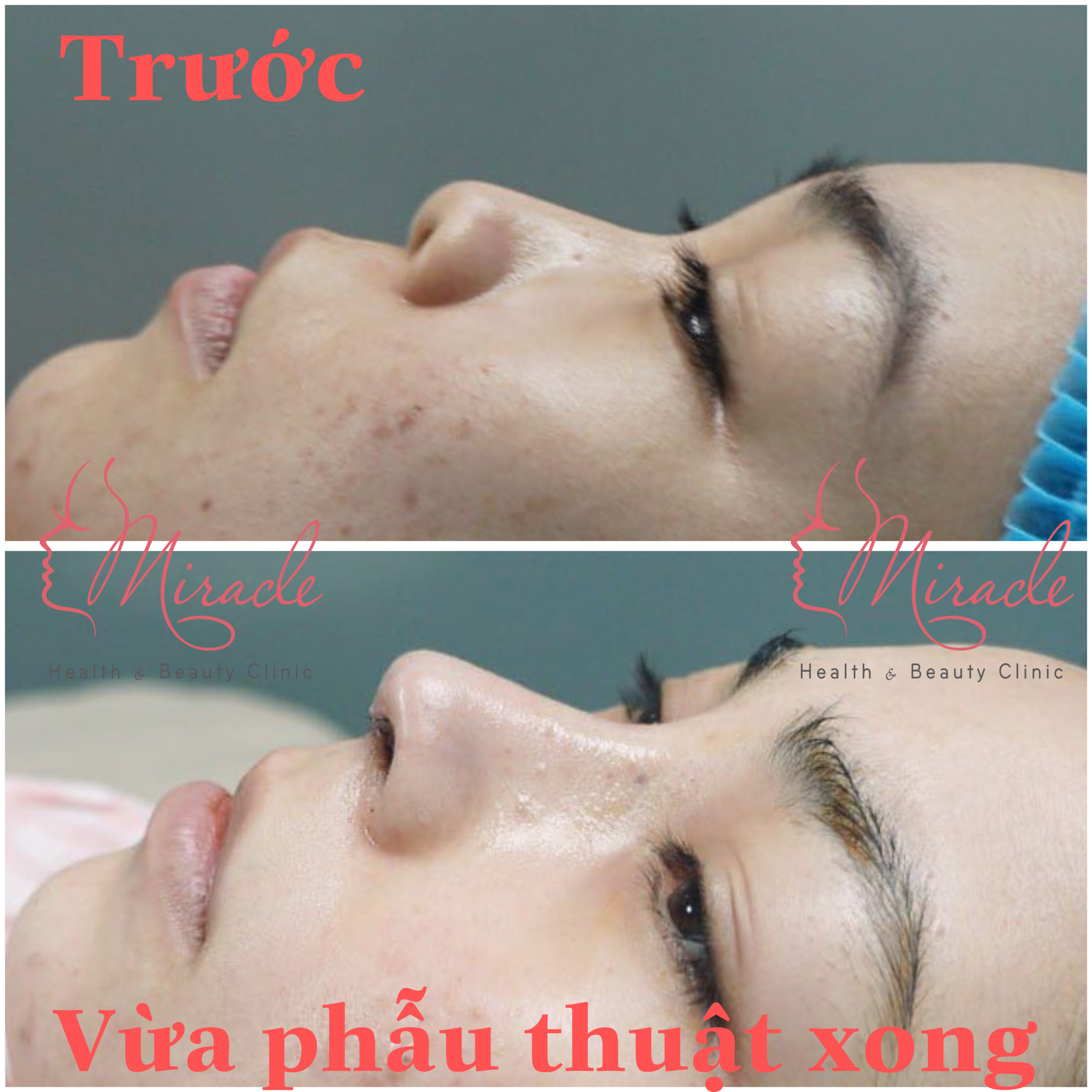 BƯỚC TIẾN MỚI TRONG ỨNG DỤNG MÁY CÔNG NGHỆ CAO INDIBA GIẢM SƯNG SAU PHẪU THUẬT TẠI MIRACLE