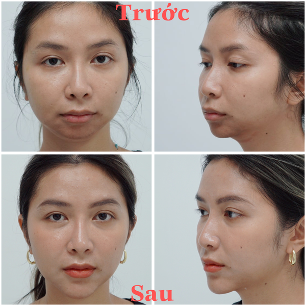 ĐỘN CẰM TỰ NHIÊN