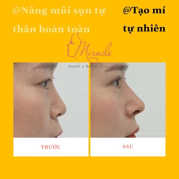 CÓ NÊN NÂNG MŨI KHÔNG ?