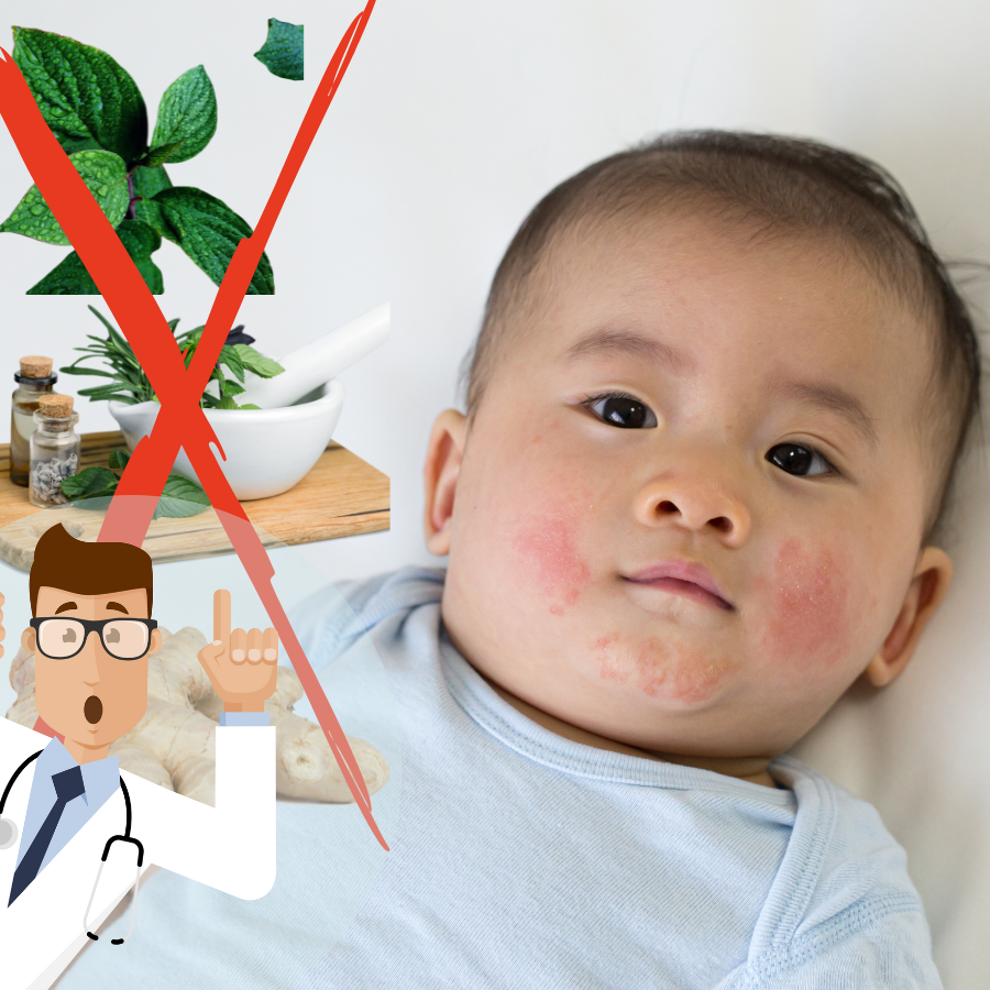 Dị Ứng Ở Trẻ Nhỏ: Mẹo Dân Gian Không Phải Lúc Nào Cũng Có Thể Áp Dụng