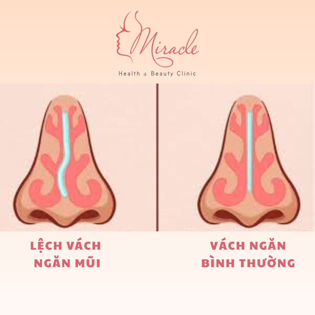 LỆCH VÁCH NGĂN MŨI CÓ NÂNG MŨI ĐƯỢC KHÔNG ?
