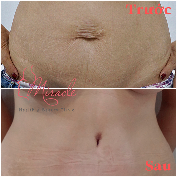 CĂNG DA BỤNG SAU SINH