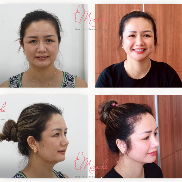 CĂNG DA MẶT TỰ NHIÊN