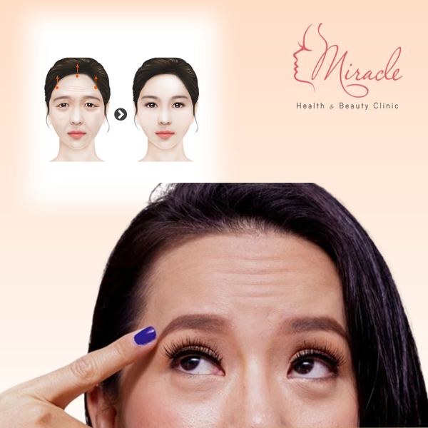 Phẫu thuật căng da trán có sẹo không?