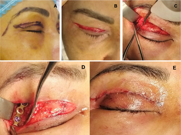 CHỈNH HÌNH PHỨC HỢP HÀM GÒ MÁ QUA ĐƯỜNG MI MẮT TRÊN