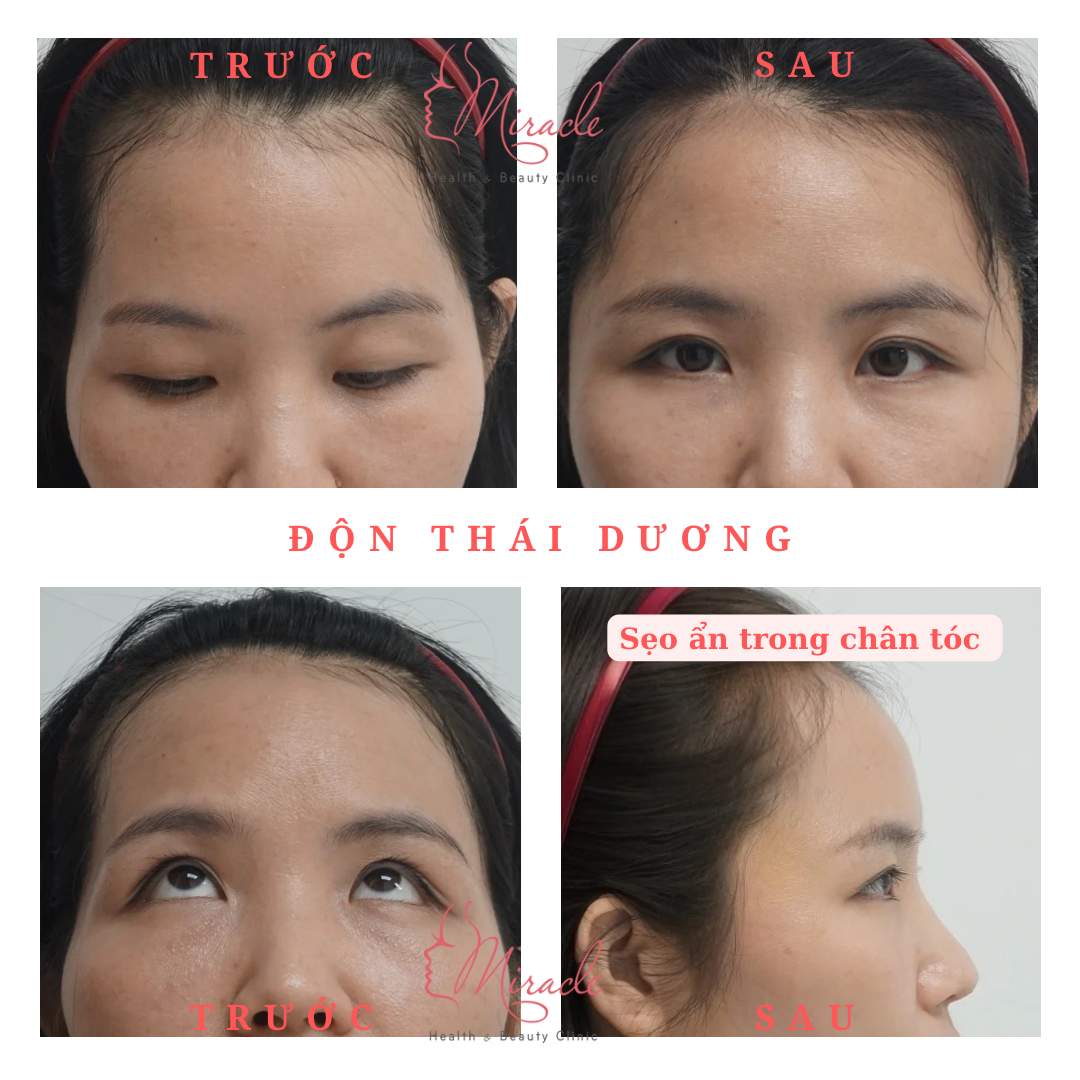 ĐỘN THÁI DƯƠNG TỰ NHIÊN