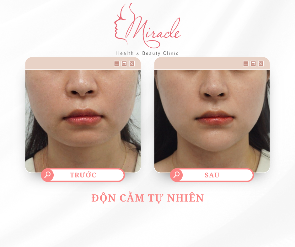 ĐỘN CẰM V LINE