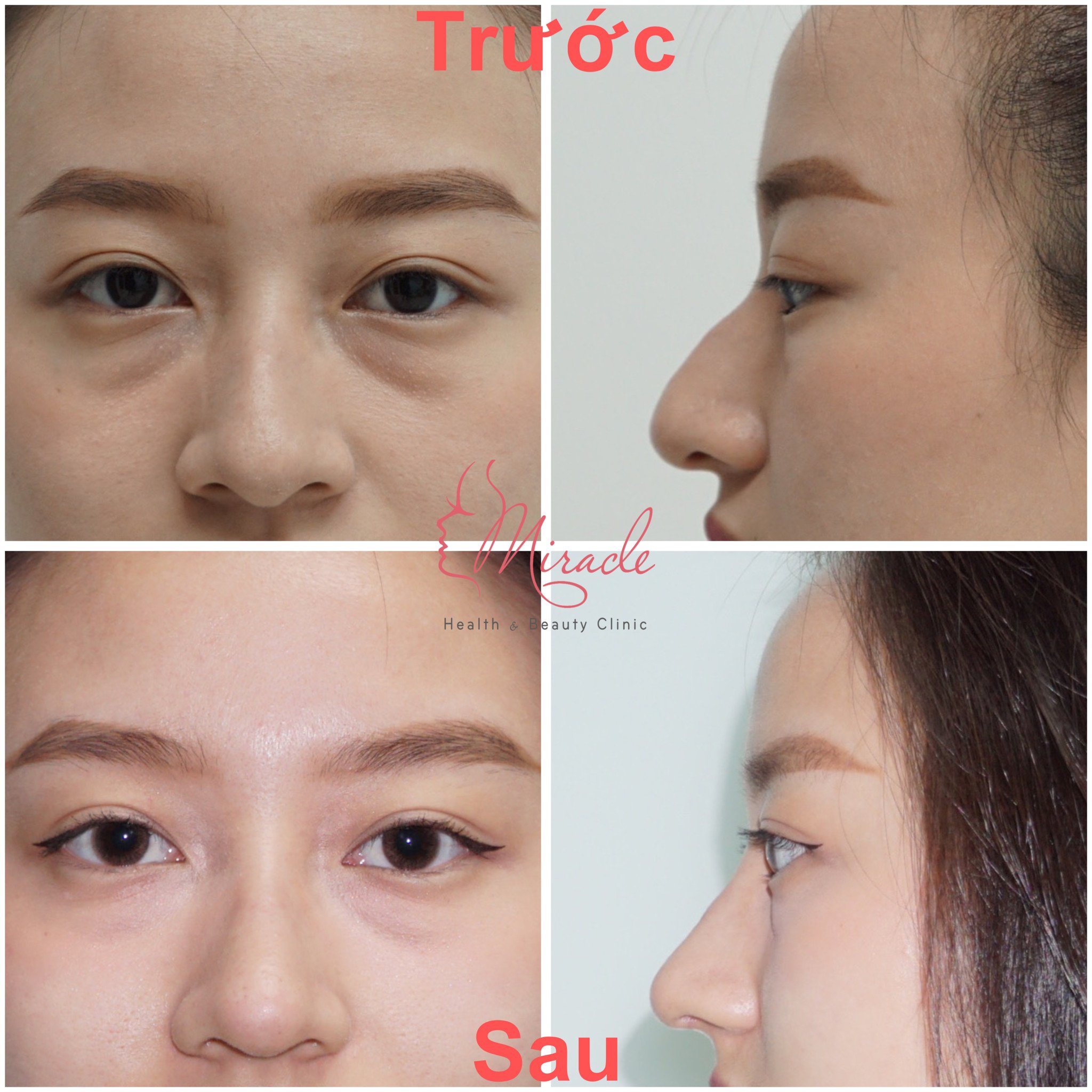 NÂNG MŨI BAO LÂU THÌ ĐẸP TỰ NHIÊN ?