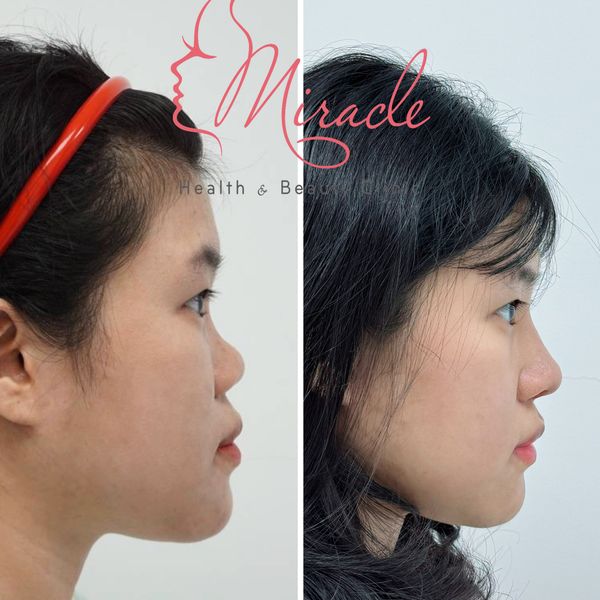 NÂNG MŨI SỤN TỰ THÂN HOÀN TOÀN