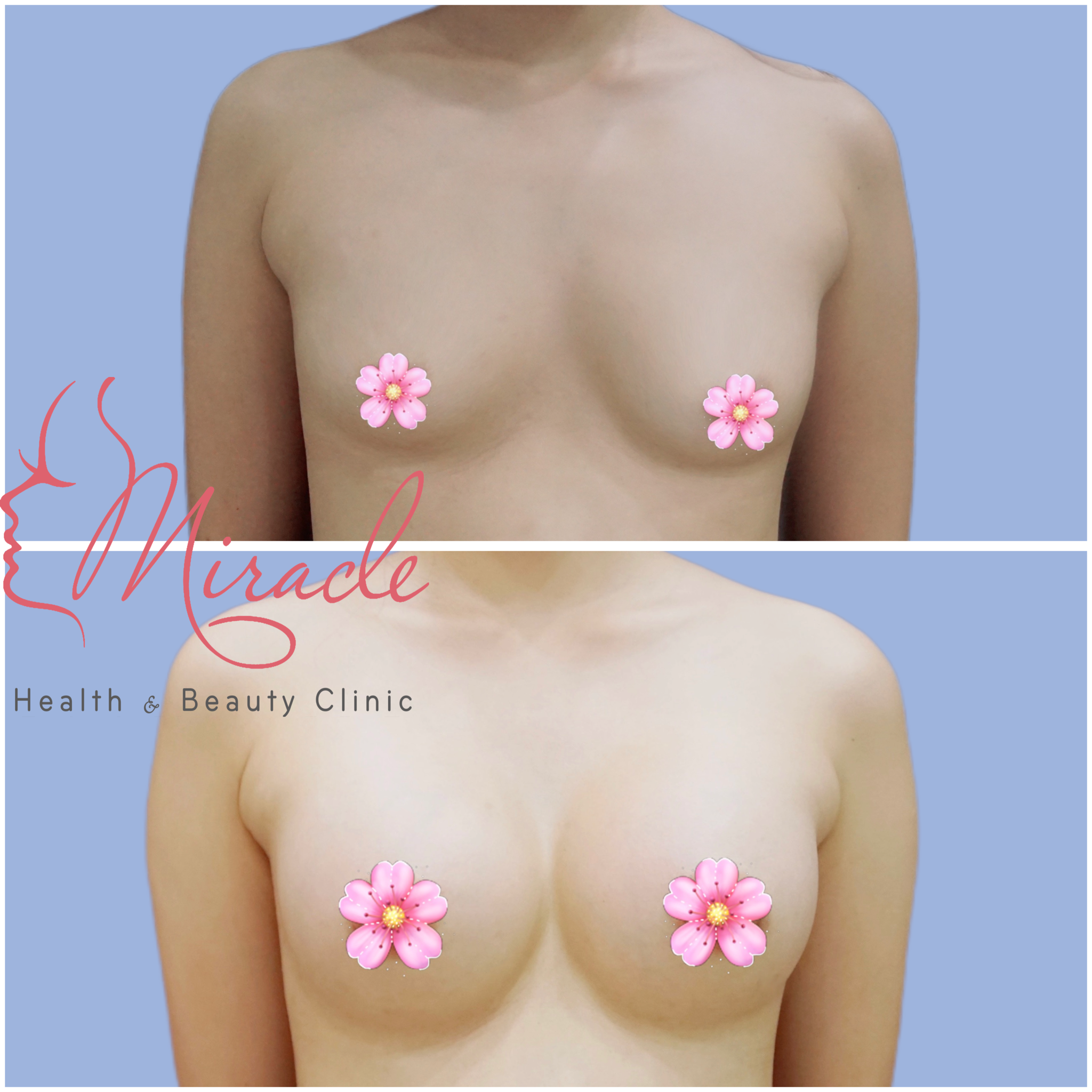 PHẪU THUẬT NÂNG NGỰC THẨM MỸ VÒNG 1 (TƯ VẤN)