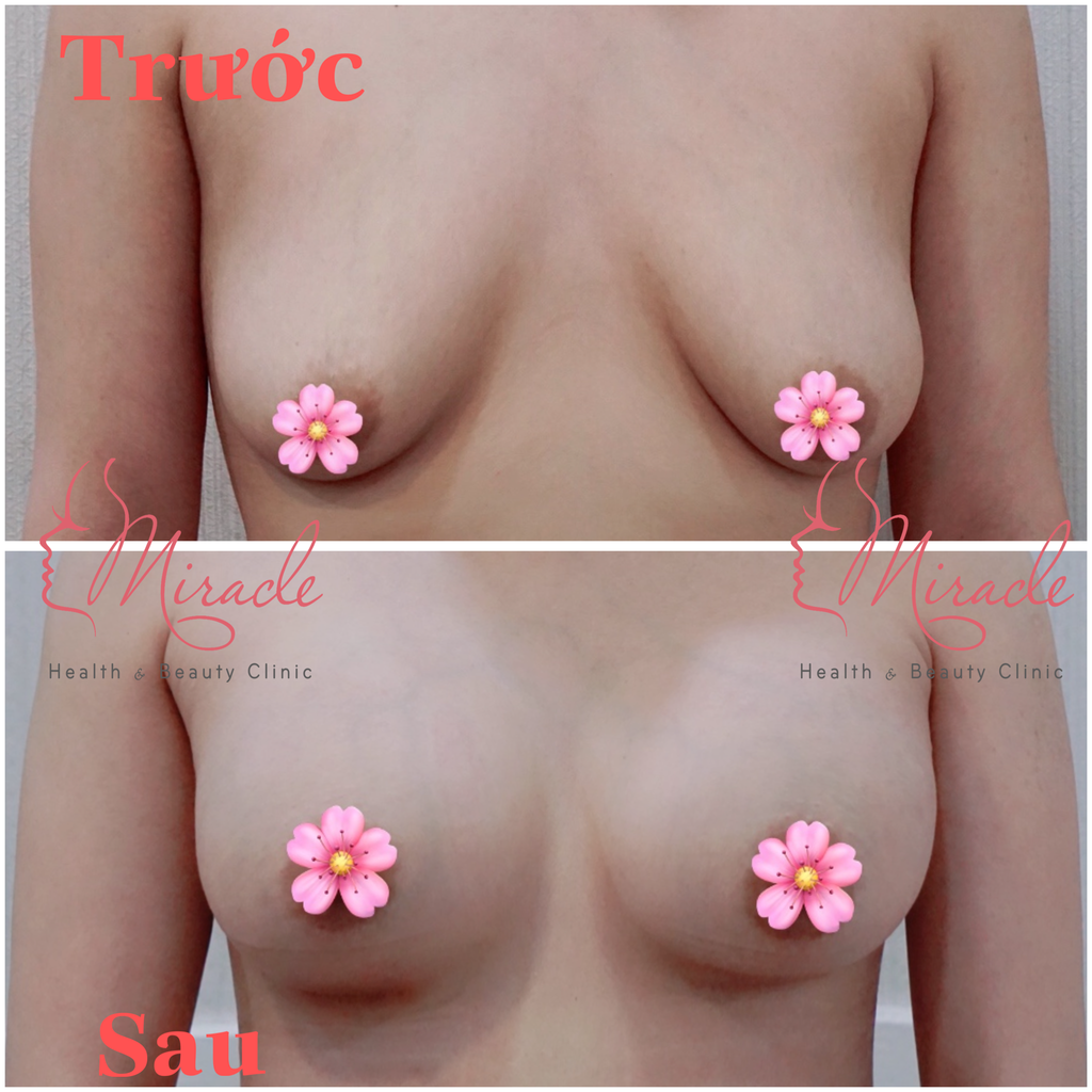 TREO SA TRỄ NÂNG NGỰC CHẢY XỆ