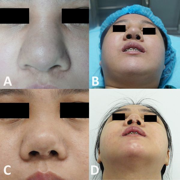 PHÒNG NGỪA VÀ XỬ TRÍ BIẾN CHỨNG PHẪU THUẬT NÂNG MŨI