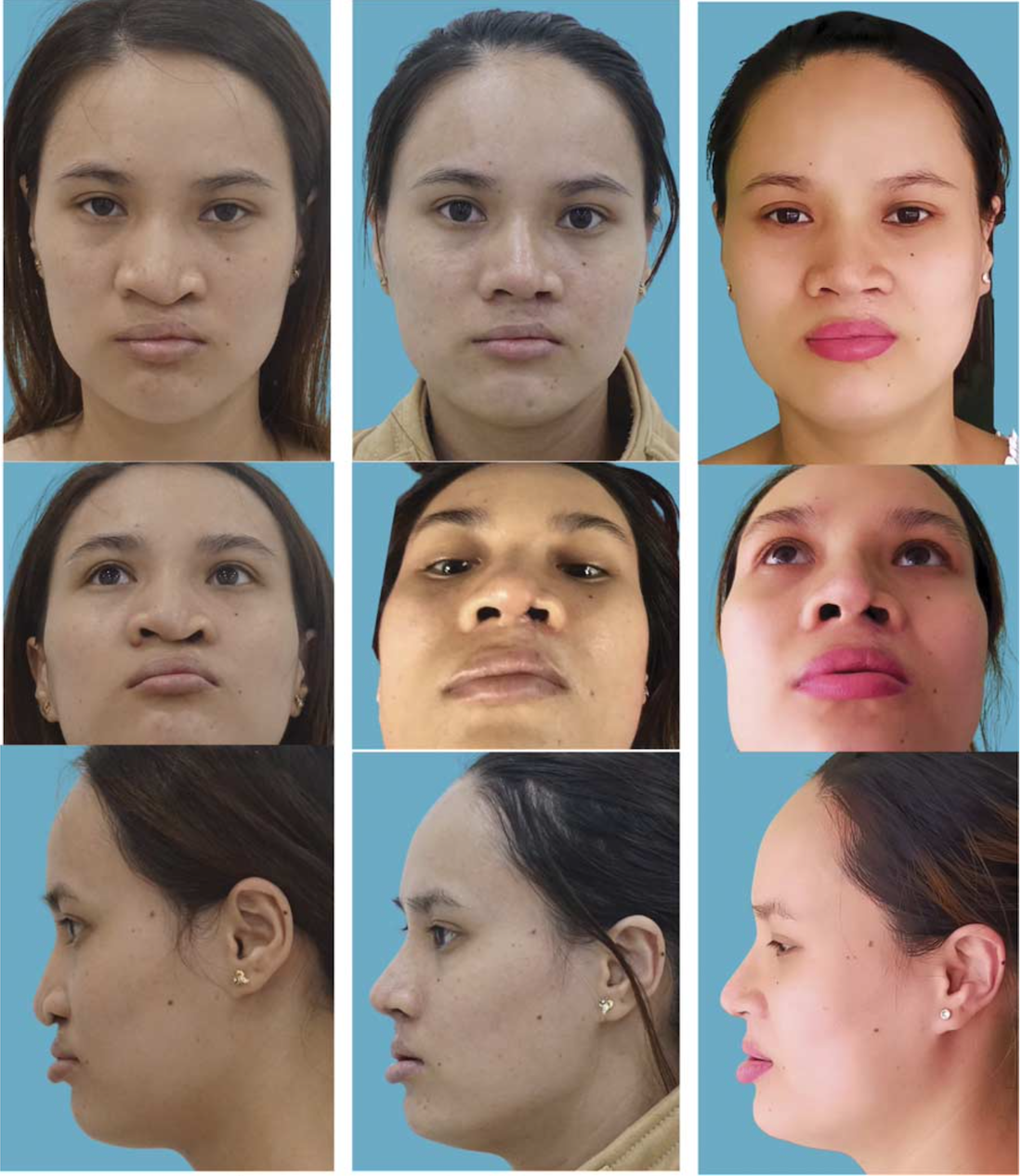 CHỈNH HÌNH MŨI SỤN TỰ THÂN CHO CÁC TRƯỜNG HỢP HỞ MÔI MỘT BÊN