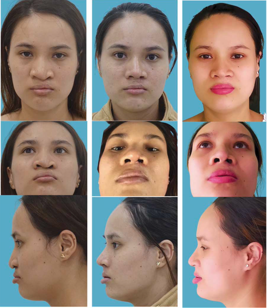 CHỈNH HÌNH MŨI SỤN TỰ THÂN CHO CÁC TRƯỜNG HỢP HỞ MÔI MỘT BÊN