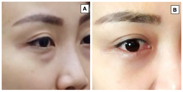 TẠO HÌNH MI DƯỚI QUA ĐƯỜNG XUYÊN KẾT MẠC