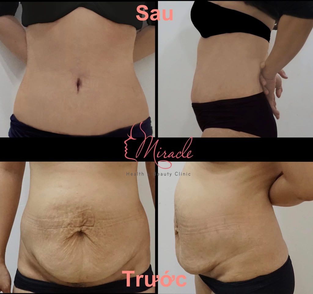 PHẪU THUẬT TẠO HÌNH THÀNH BỤNG (TƯ VẤN)