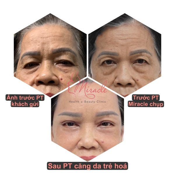 Cang da mat tu nhien ca 4