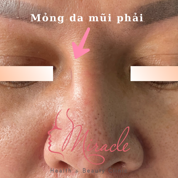 Bien chung mong da mui phai
