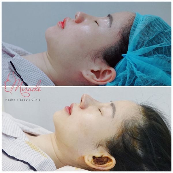 Nang mui sun tu than ca 2 moi