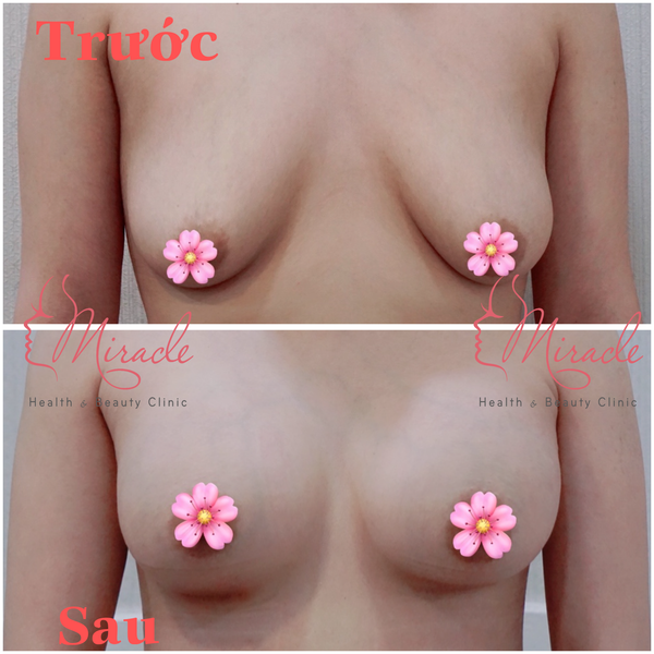 Nang nguc sau sinh tai Miracle