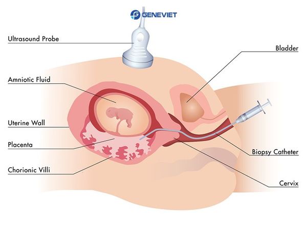 Những lưu ý quan trọng khi thực hiện xét nghiệm ADN huyết thống thai nhi