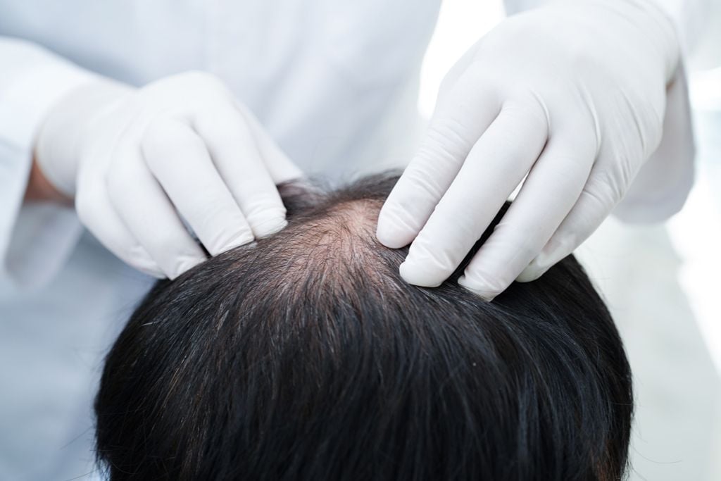 Rụng Tóc Từng Mảng: Dấu Hiệu, Nguyên Nhân Và Phương Pháp Điều Trị