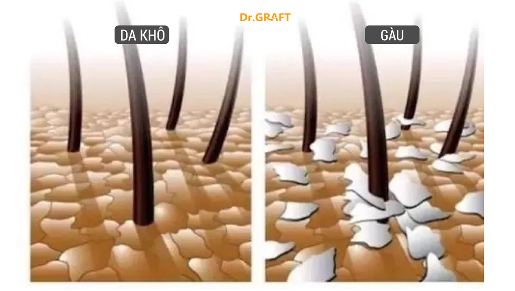 Phân Biệt Gàu và Da Khô: Nguyên Nhân, Triệu Chứng và Cách Chăm Sóc