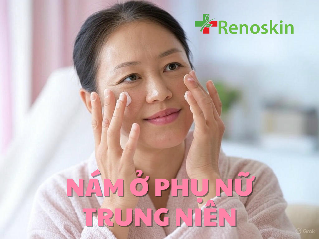 Nguyên nhân gây nám ở phụ nữ trung niên và cách khắc phục