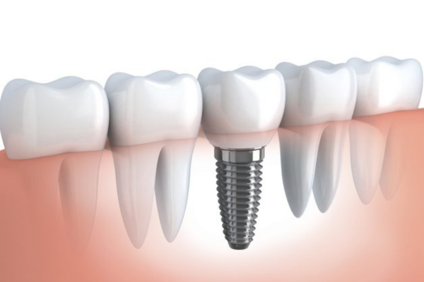 Các vấn đề về xương trong cấy ghép Implant