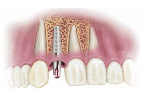 Nguyên nhân thất bại và phương pháp đảm bảo tích hợp xương trong cấy ghép Implant