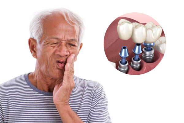 [Góc kiến thức] Cần chuẩn bị gì trước khi cấy ghép Implant?