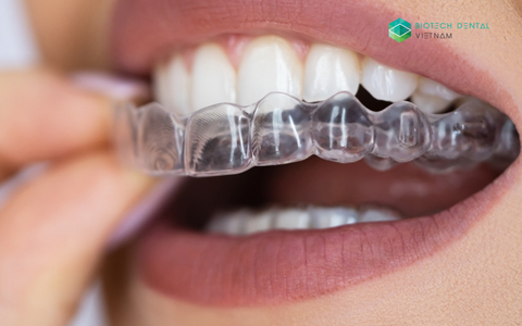 Điều trị chỉnh nha bằng khay niềng răng trong suốt và hiệu quả so với niềng răng mắc cài