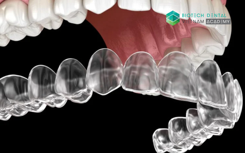 Cập nhật sự tiến bộ trong kỹ thuật điều trị niềng răng trong suốt