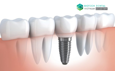 Tầm quan trọng của sự ổn định trong cấy ghép Implant