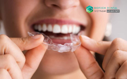 Phương pháp tăng tốc độ niềng răng trong suốt với liệu pháp điều chế quang sinh học