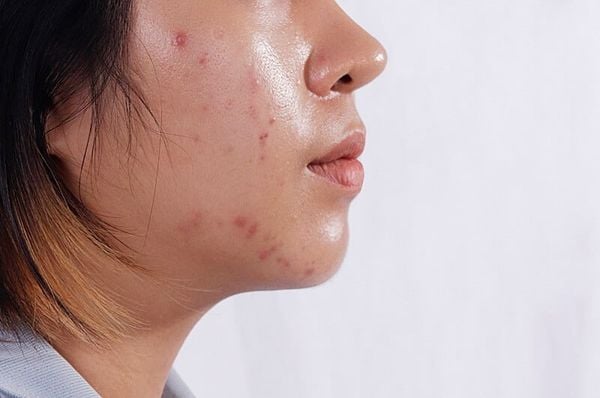 da dầu có nên dùng kem nền collagen không
