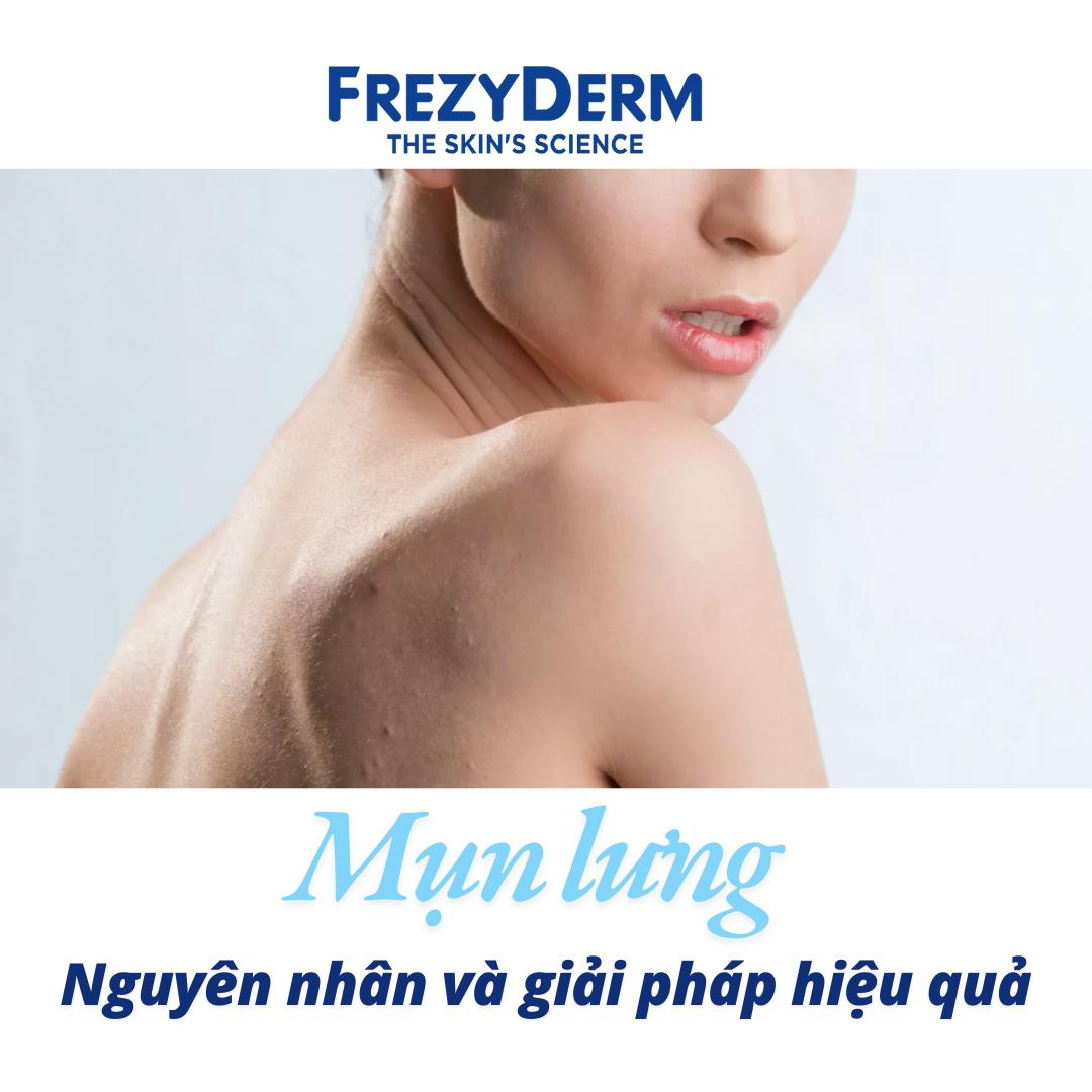 MỤN Ở LƯNG: NGUYÊN NHÂN VÀ GIẢI PHÁP HIỆU QUẢ