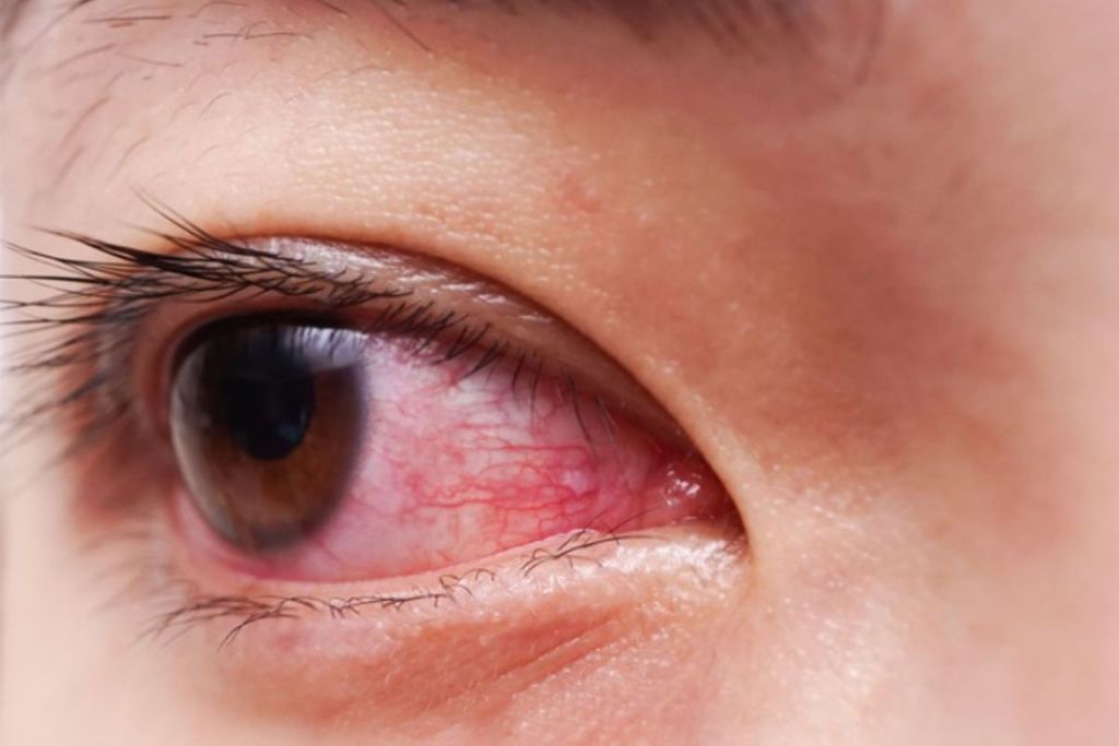 Mẹo phòng tránh bệnh đau mắt đỏ