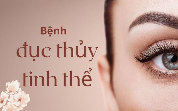 Bệnh đục thủy tinh thể : nguyên nhân, triệu chứng và cách điều trị