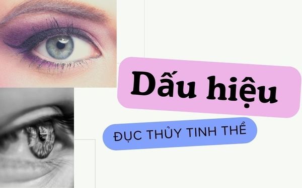 Nhận biết dấu hiệu đục thủy tinh thể - Lời khuyên từ chuyên gia