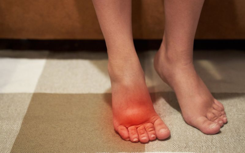 triệu chứng gút ở chân là sưng đỏ