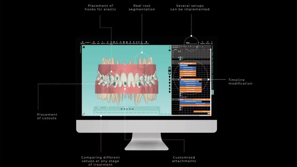 Mô phỏng kết quả niềng răng với ứng dụng NEMOCAST