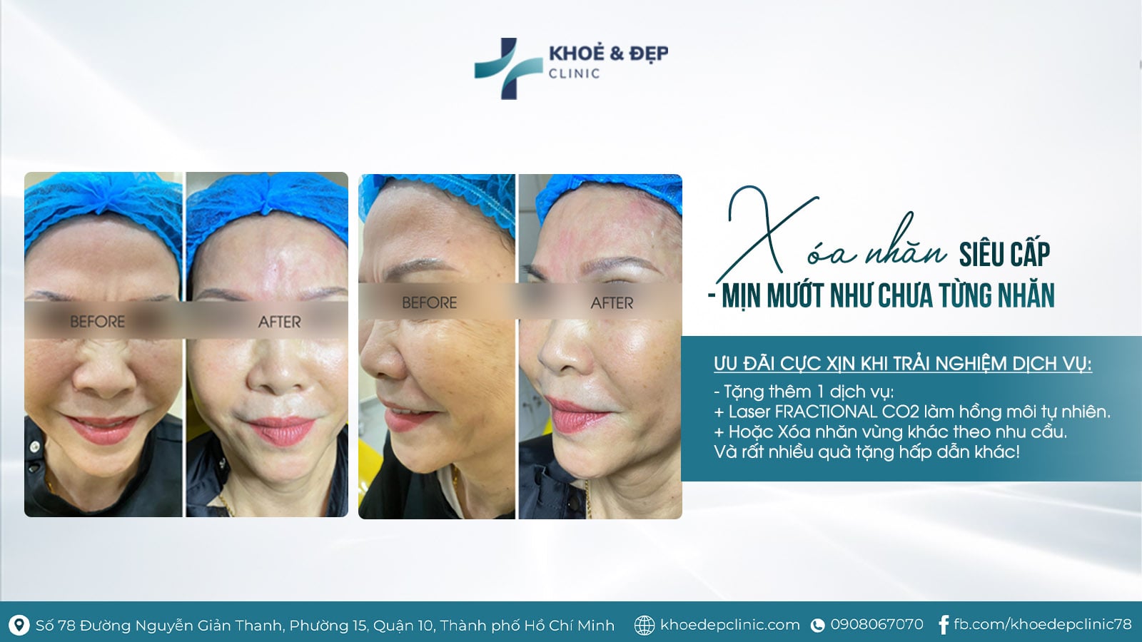 XÓA NHĂN SIÊU CẤP - MỊN MƯỚP NHƯ CHƯA TỪNG NHĂN