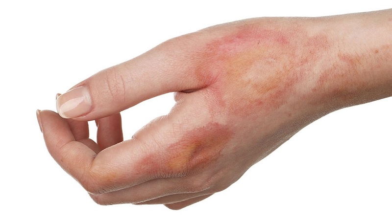 Sẹo bỏng: cách trị bỏng không để lại sẹo hiệu quả